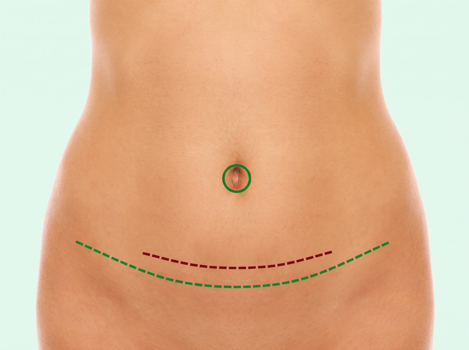 Bauchdeckenstraffung (Abdominoplastik) beim Facharzt in Dresden