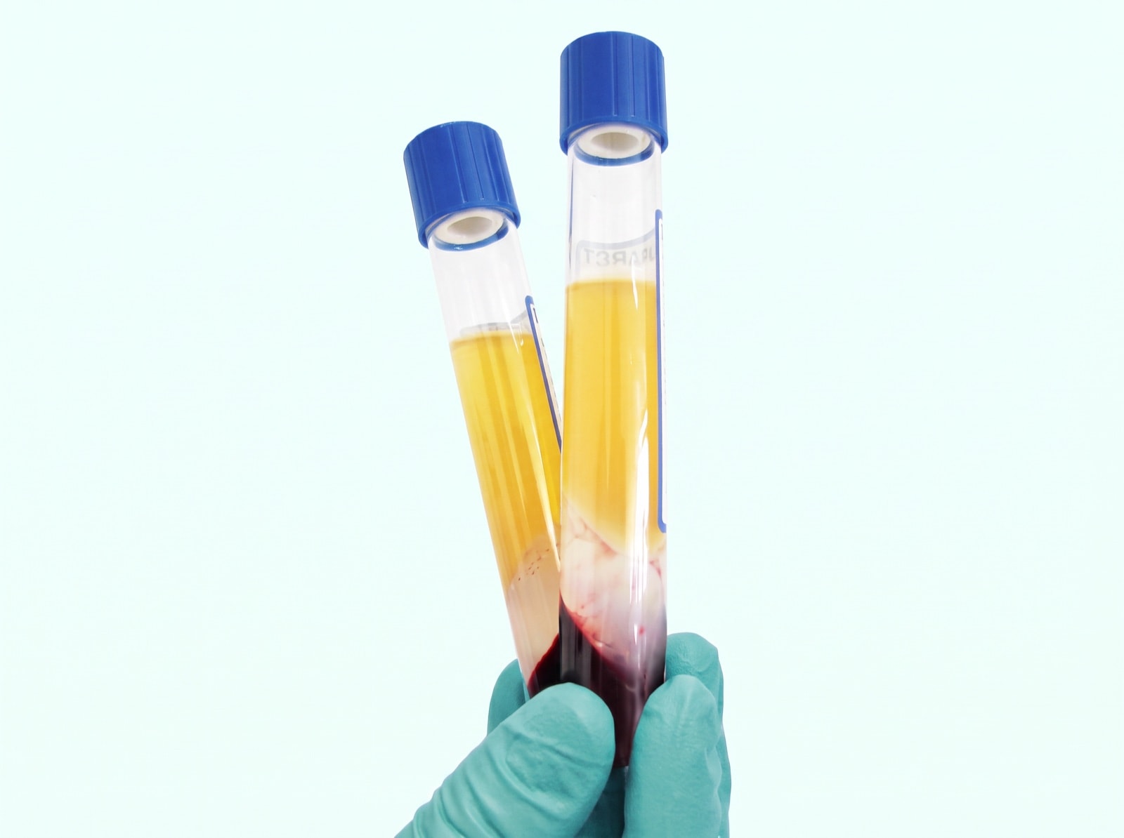 Ablauf der PRP-Eigenbluttherapie